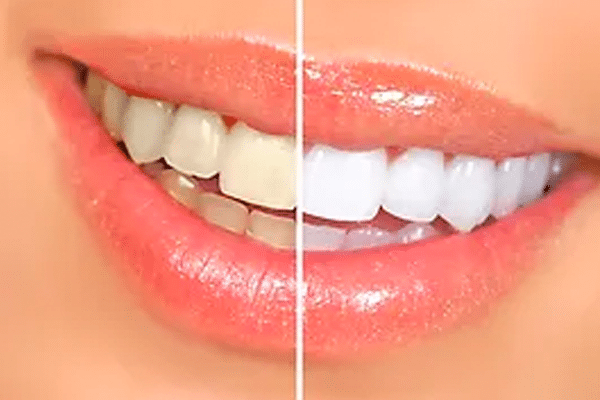 Cotton Tree Teeth Whitening Dental Services