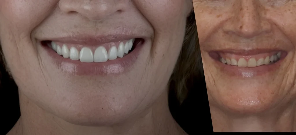 Women Before After Case Gum Treatment