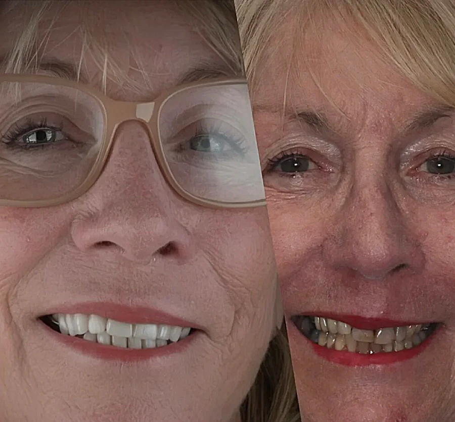 A split-image showing a close-up of a woman's face before and after dental work. On the left, she smiles with shiny teeth and wears glasses, conveying happiness. On the right, her teeth appear less uniform, and her expression is neutral.