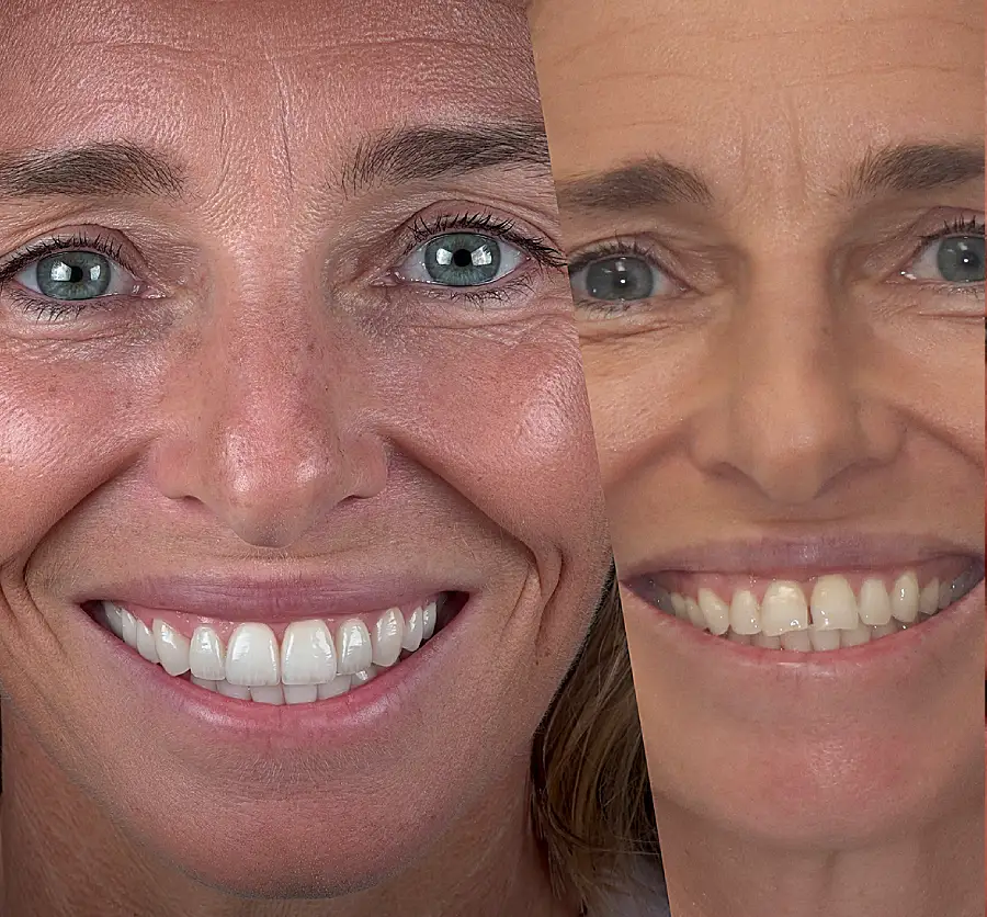 Close-up of a woman's smiling face, showing a before-and-after comparison of dental work. Her expression is joyful, highlighting bright, even teeth.