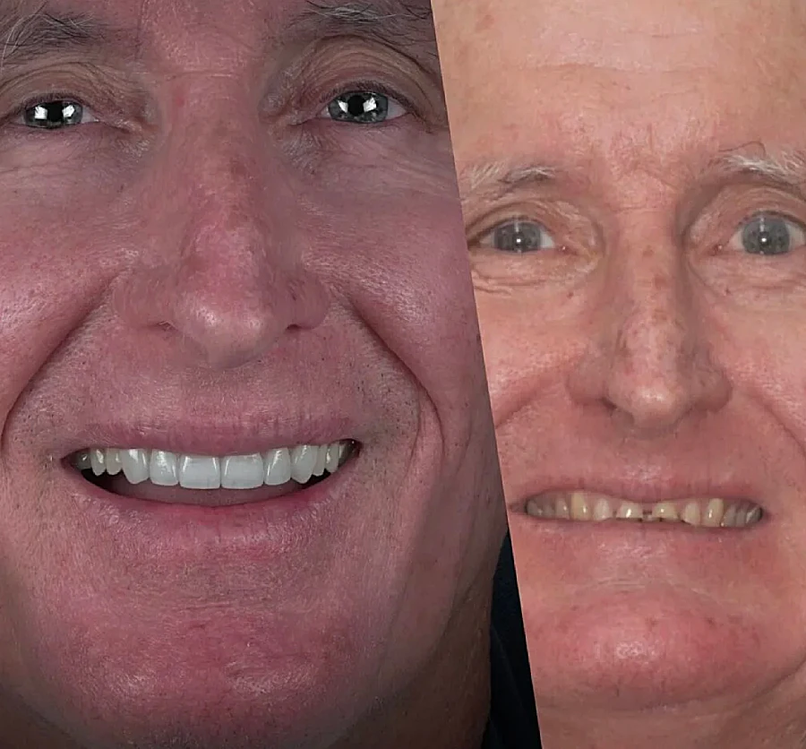 Split image showing a man's face before and after dental work, with emphasis on the teeth. Left side shows bright, even teeth; right side shows discolored, uneven teeth.