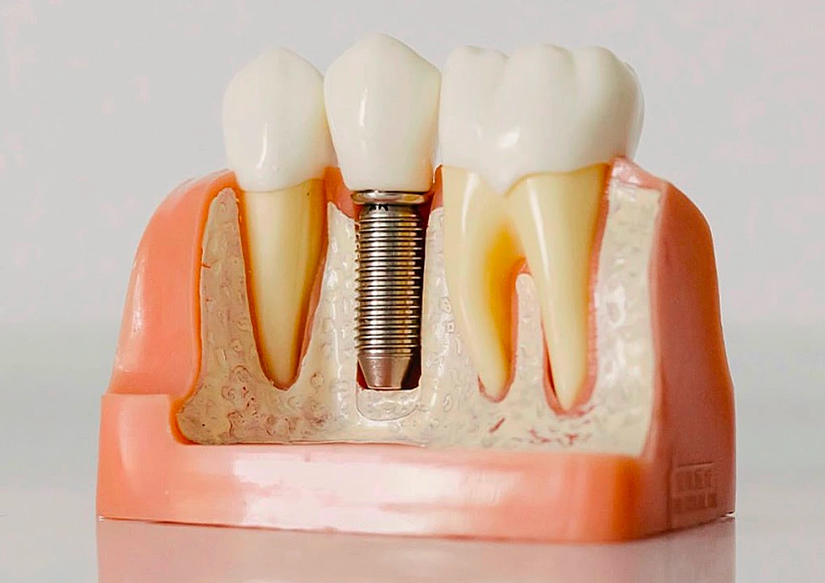 Dental implant model showing a replacement tooth anchored in the jawbone.